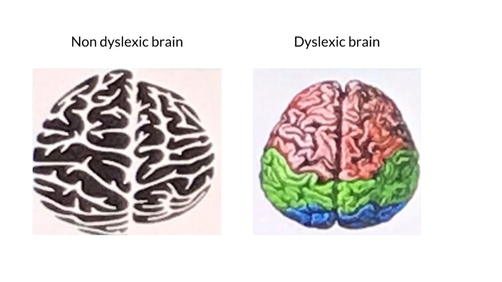 dyslexic brain